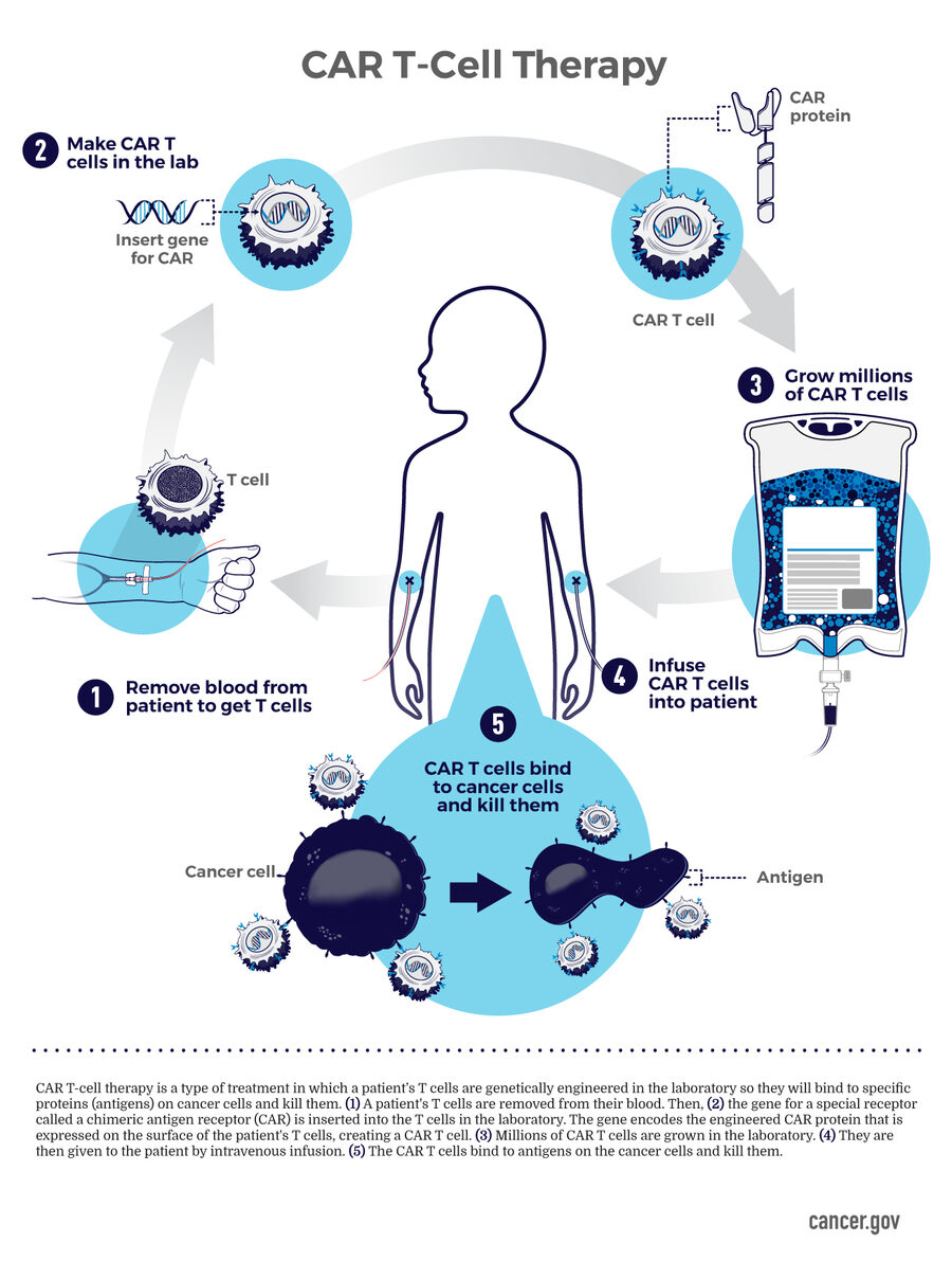 Diagram of CAR T-cell therapy: T cells are collected from a patient's blood, engineered in a lab to carry a receptor that recognizes cancer, multiplied, and infused back into the patient.