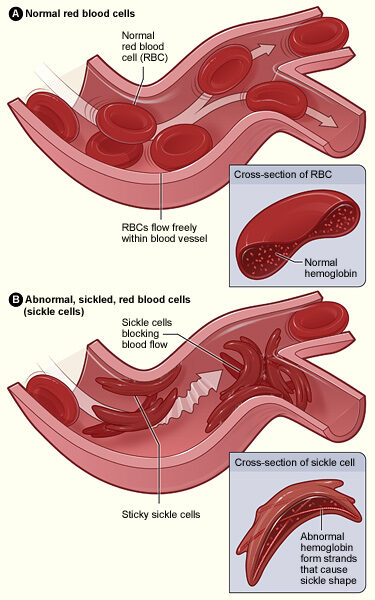 Illustration comparing round red blood cells flowing freely through a blood vessel with stiff crescent-shaped sickle cells that stick together and block the flow.
